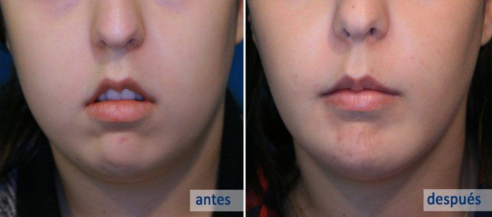 Qué son las Bolas de Bichat - Cirugía Estética en Asturias - CLÍNICA FERNÁNDEZ 