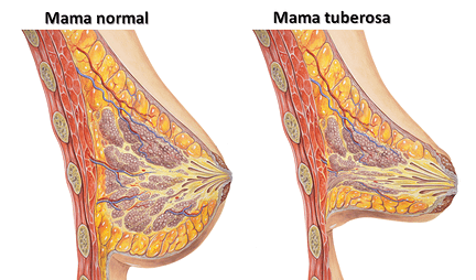 Cómo identificar las mamas tuberosas