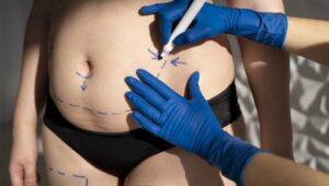 Diferencias entre abdominoplastia y miniabdominoplastia