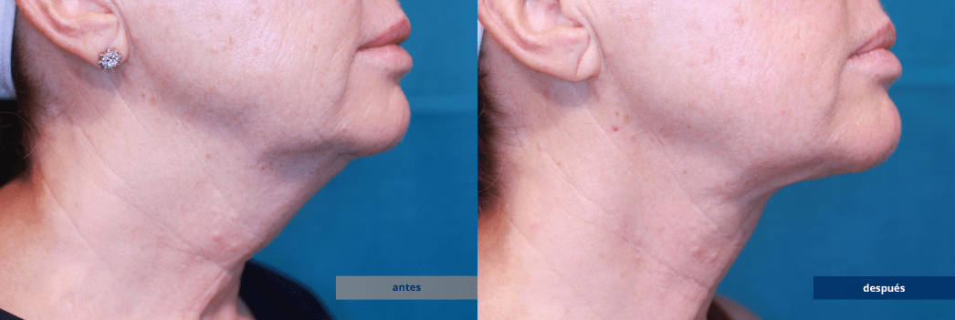 NECKTITE-1-ANTES-DESPUES