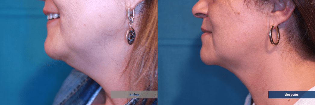 NECKTITE-2-ANTES-DESPUES-2