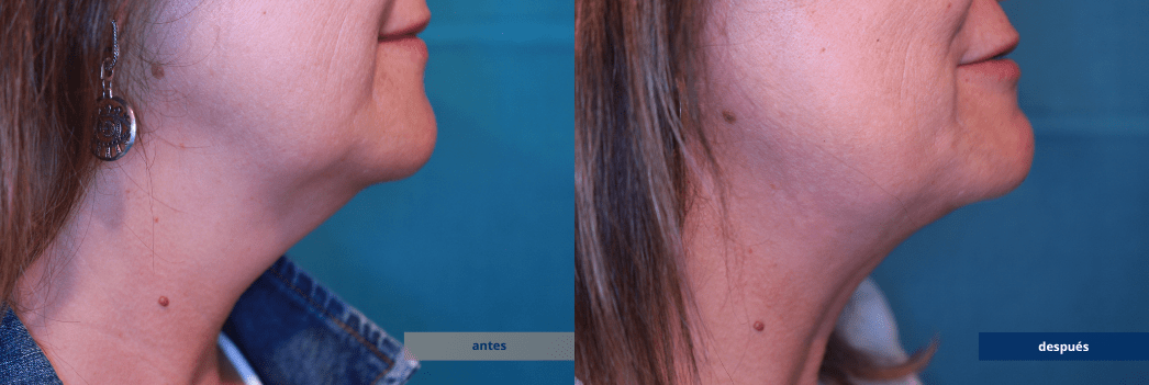 NECKTITE-2-ANTES-DESPUES