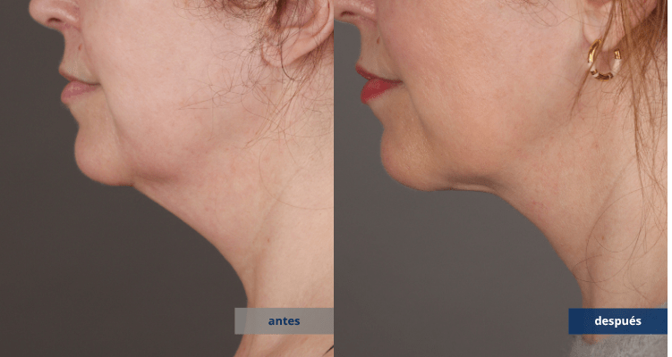 NECKTITE-3-ANTES-DESPUES-PERFIL-2