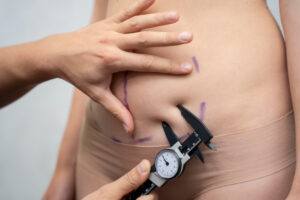 Abdominoplastia en Asturias: Beneficios, recuperación y resultados reales