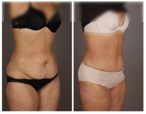 abdominoplastia en Asturias