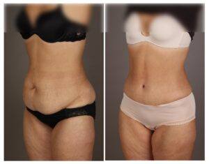 abdominoplastia en Asturias