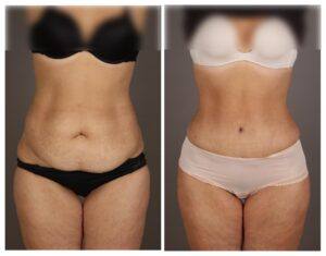 abdominoplastia en Asturias