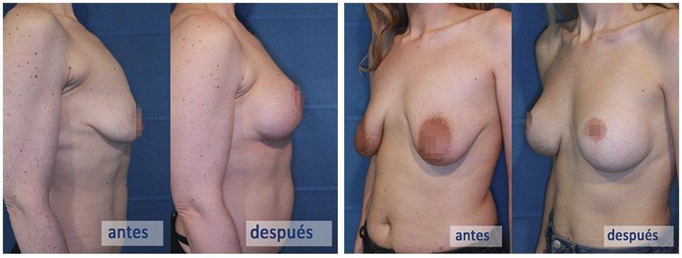 cirugía de elevación mamaria o mastopexia