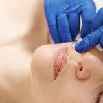 Mujer tratanto sus arrugas en el labio superior. Clínica Fernández. Cirugía Estética en Asturias