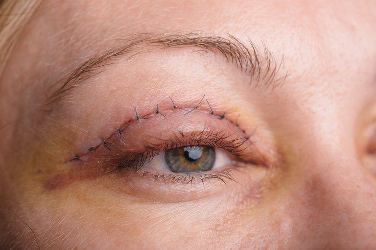 Ojos después de intervención de blefaroplastia en Clínica Fernández.